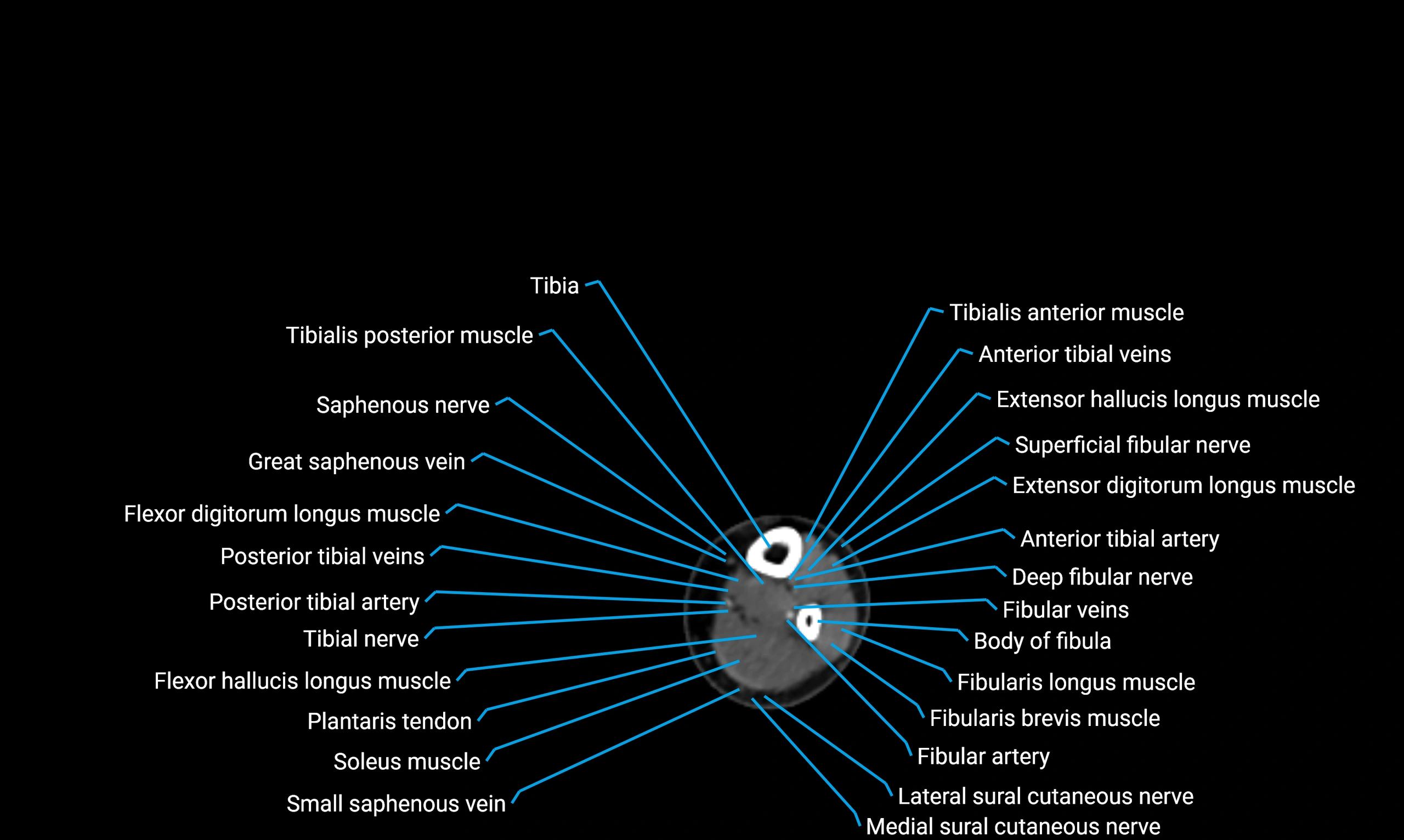 CT lower limb axial cross sectional anatomy labelled image 144 (2).webp